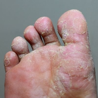 Athletes Feet